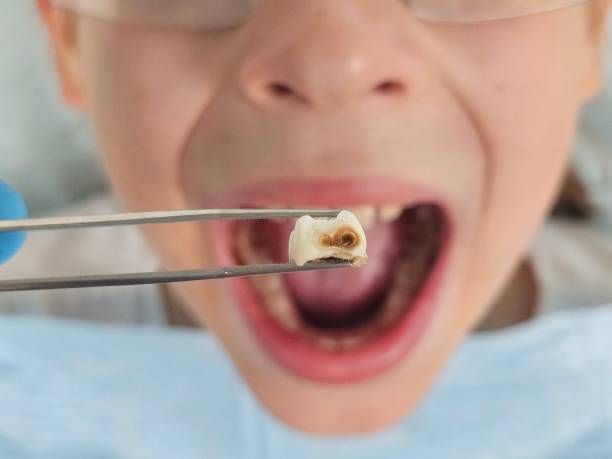 Best Emergency Dental Care for Abscessed Tooth in Dublin, GA